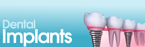 Dental Implant Dental Implant
