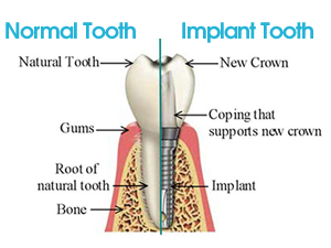 Dental Implant Doncaster Dental Implant Doncaster